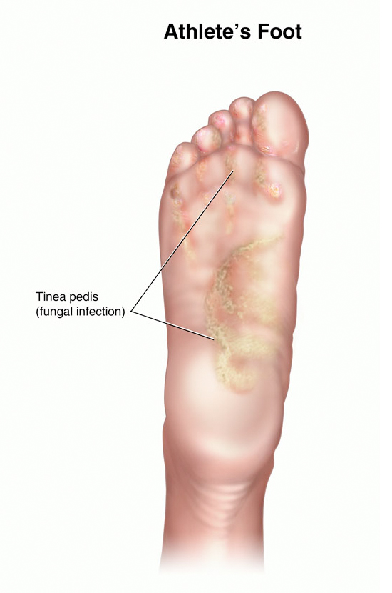 Colloidal Silver For Athlete's Foot & Fungus on Skin